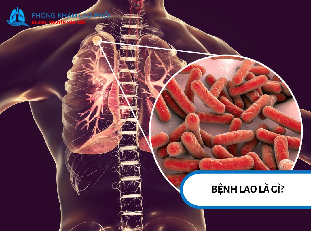 Bệnh lao là một bệnh truyền nhiễm do vi khuẩn có tên là Mycobacterium tuberculosis gây ra