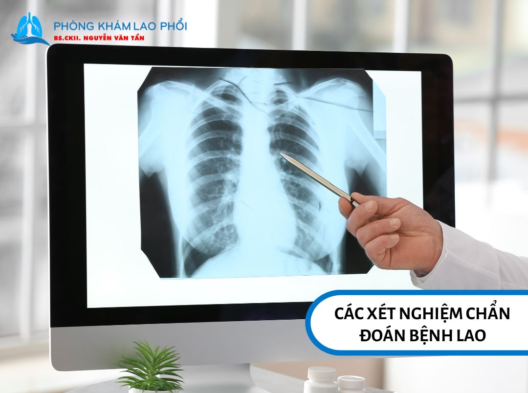Các xét nghiệm chẩn đoán bệnh lao
