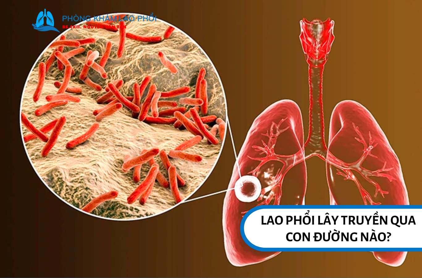 Lao phổi do vi khuẩn Mycobacterium tuberculosis (MTB) gây ra