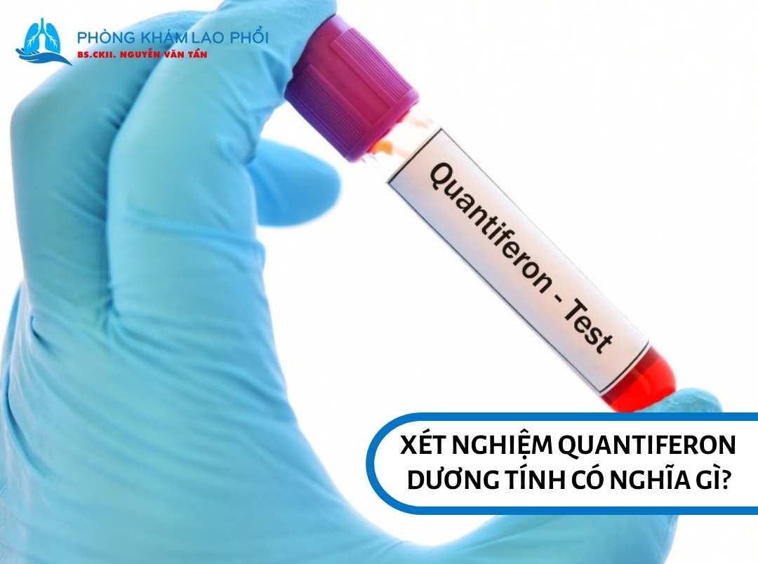 Xét nghiệm Quantiferon dương tính có nghĩa gì?