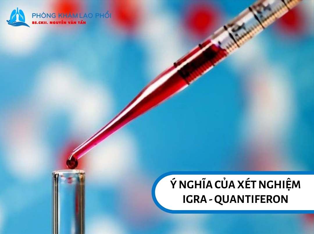 Ý nghĩa của xét nghiệm IGRA - Quantiferon