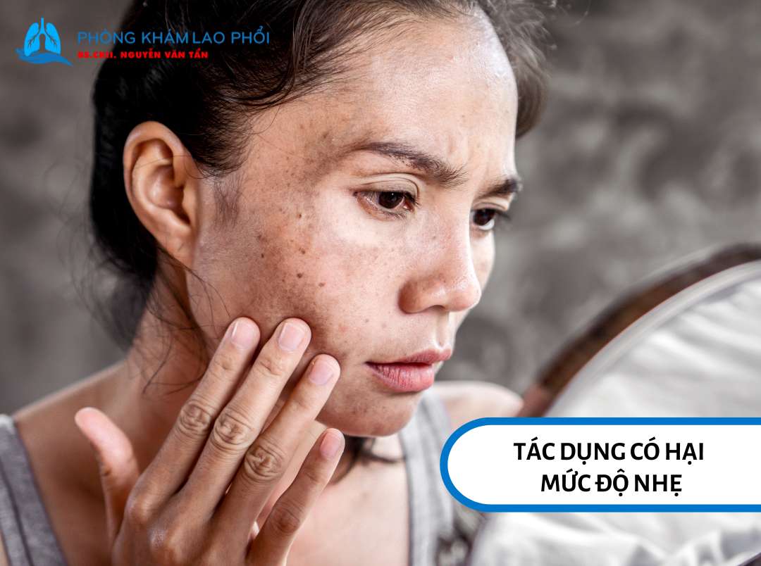 Sạm da là tác dụng có hại mức độ nhẹ của thuốc điều trị lao