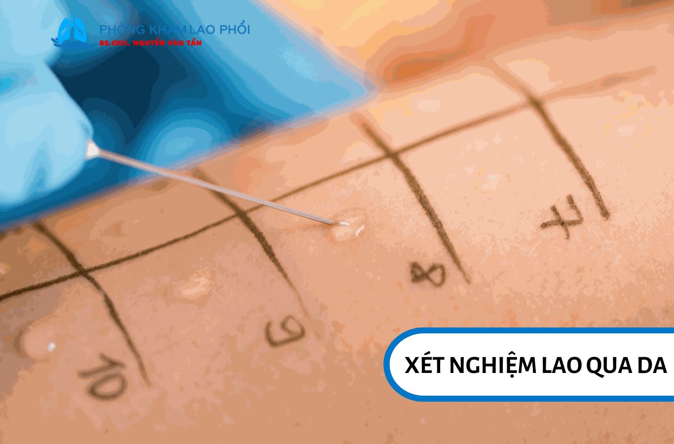 Để hiểu rõ TB test là gì, bạn có thể tìm hiểu về TST – Xét nghiệm lao qua da, một trong hai phương pháp phổ biến được sử dụng