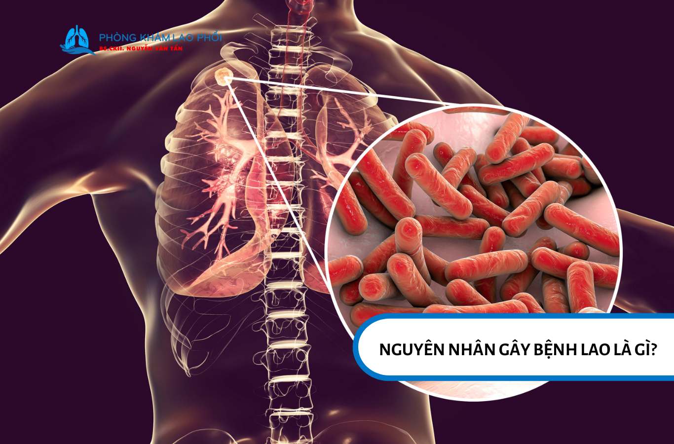Bệnh lao do vi khuẩn Mycobacterium tuberculosis gây ra, lây qua không khí khi người bệnh ho hoặc hắt hơi