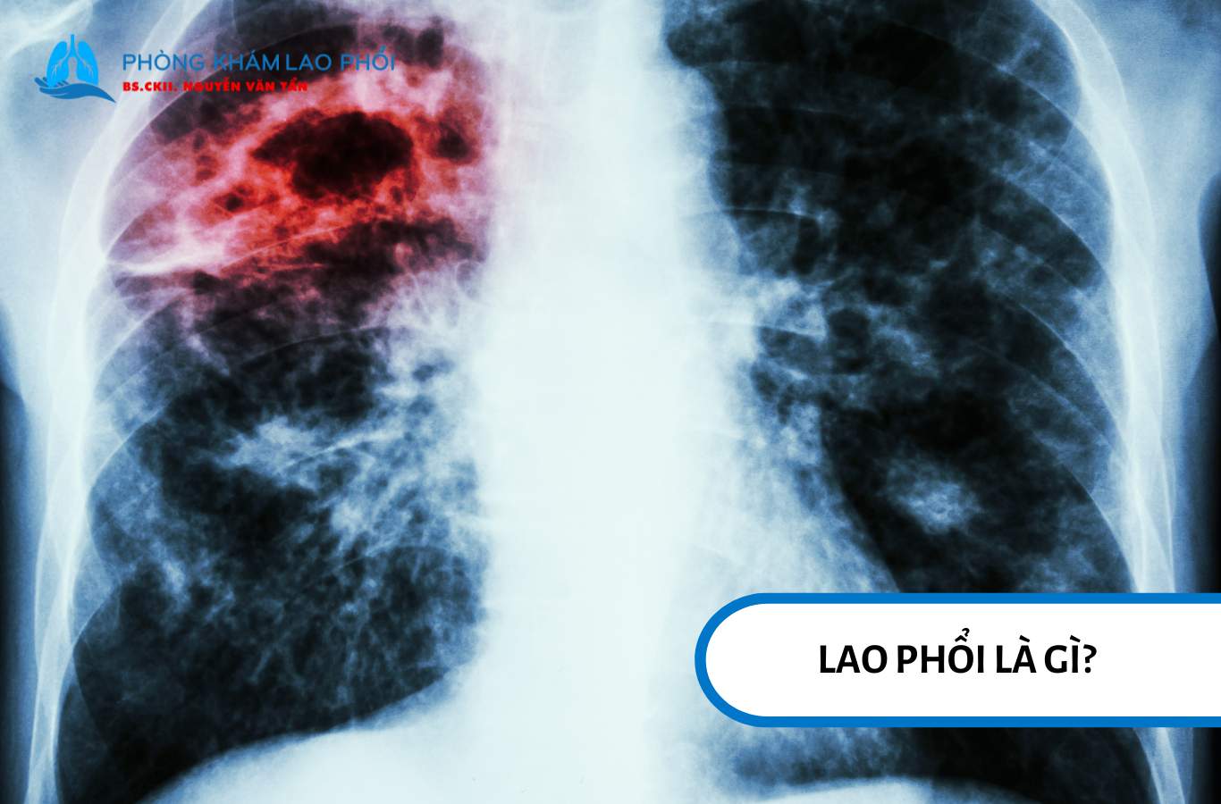 Mỗi năm có khoảng 10 triệu ca mắc lao phổi