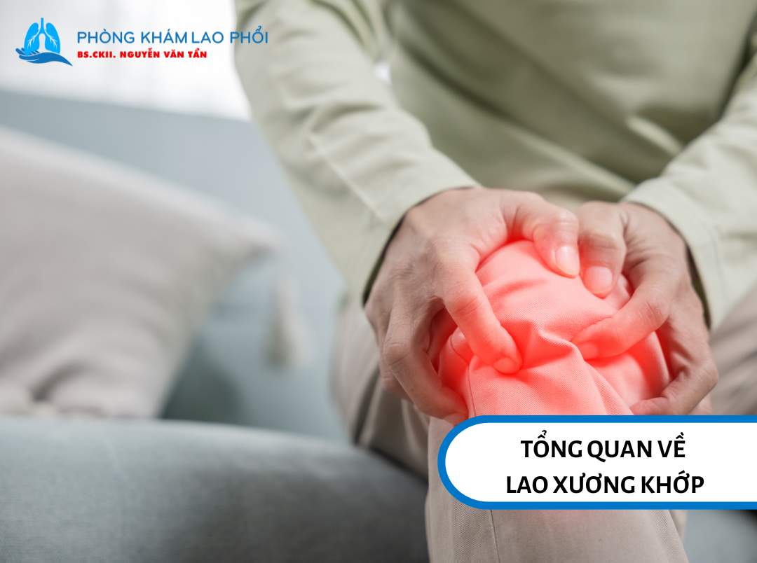 Lao xương khớp xảy ra khi vi khuẩn lao tấn công vào xương và khớp thay vì phổi