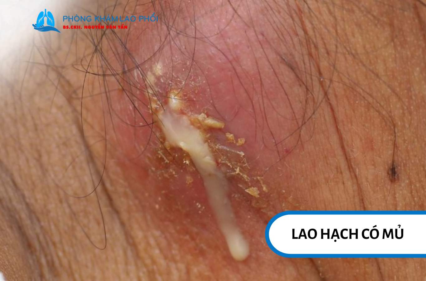 Lao hạch có mủ