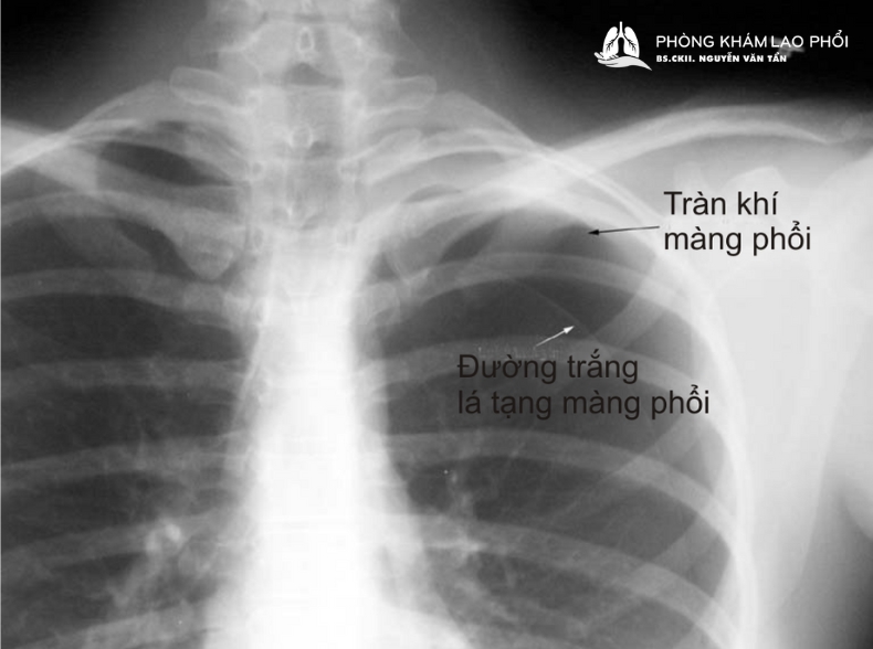 Cách nhận biết tràn khí màng phổi qua chụp CT ngực