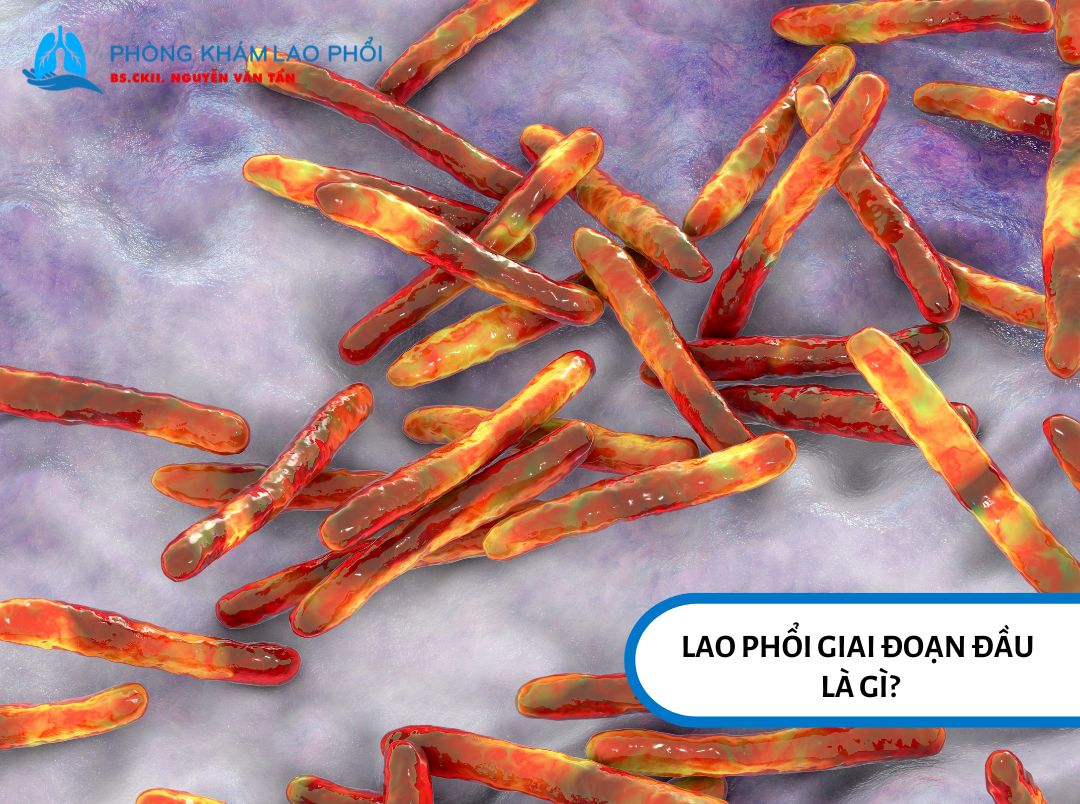 Lao phổi giai đoạn đầu là thời điểm cơ thể mới bị nhiễm vi khuẩn lao 