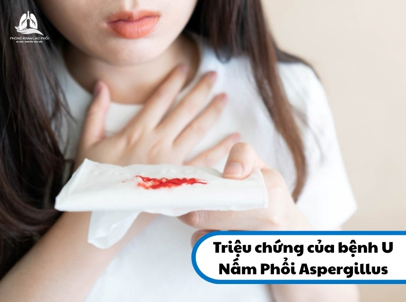 Hầu hết các báo cáo cho thấy ho ra máu là triệu chứng phổ biến