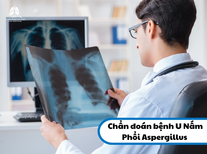 Cách chẩn đoán bệnh U Nấm Phổi Aspergillus