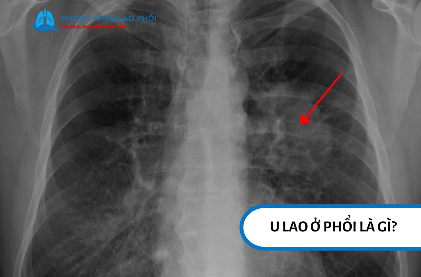U lao ở phổi hình thành khi vi khuẩn Mycobacterium tuberculosis bị cô lập bởi các tế bào miễn dịch