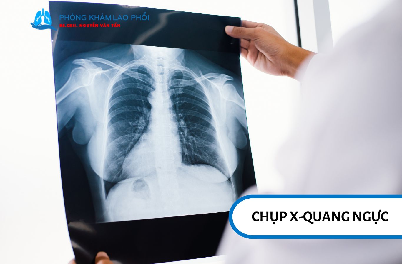 Để chẩn đoán u lao ở phổi, bác sĩ thường bắt đầu với chụp X-quang ngực