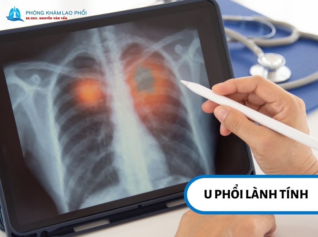 Khối u lành tính có ranh giới tương đối rõ trên hình ảnh phổi