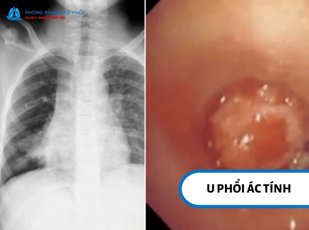 Khối u phổi có hình dạng và đặc điểm bất thường