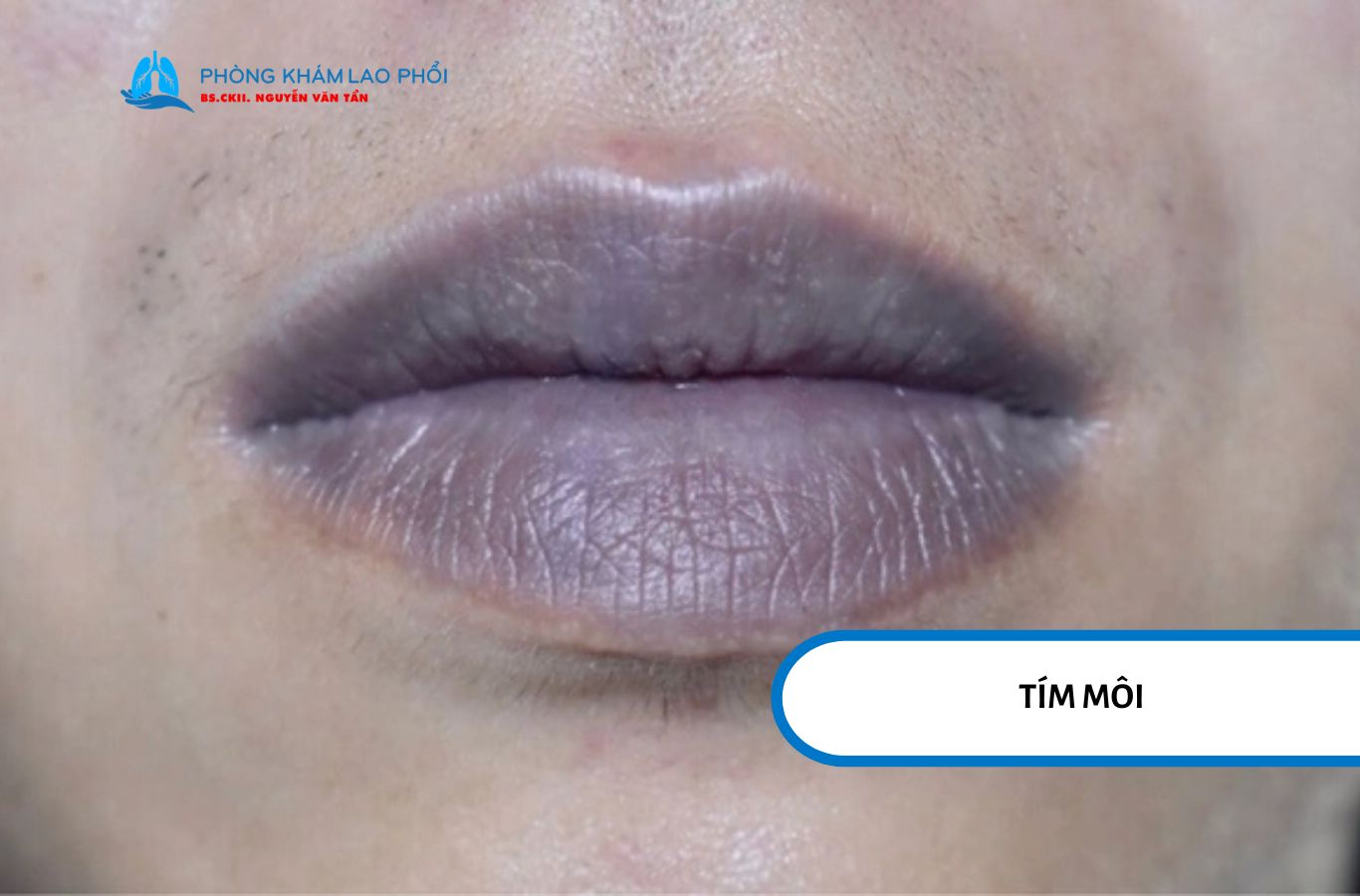 Khó thở tăng dần, kèm đau ngực, tím môi hay ho ra máu cần khám gấp