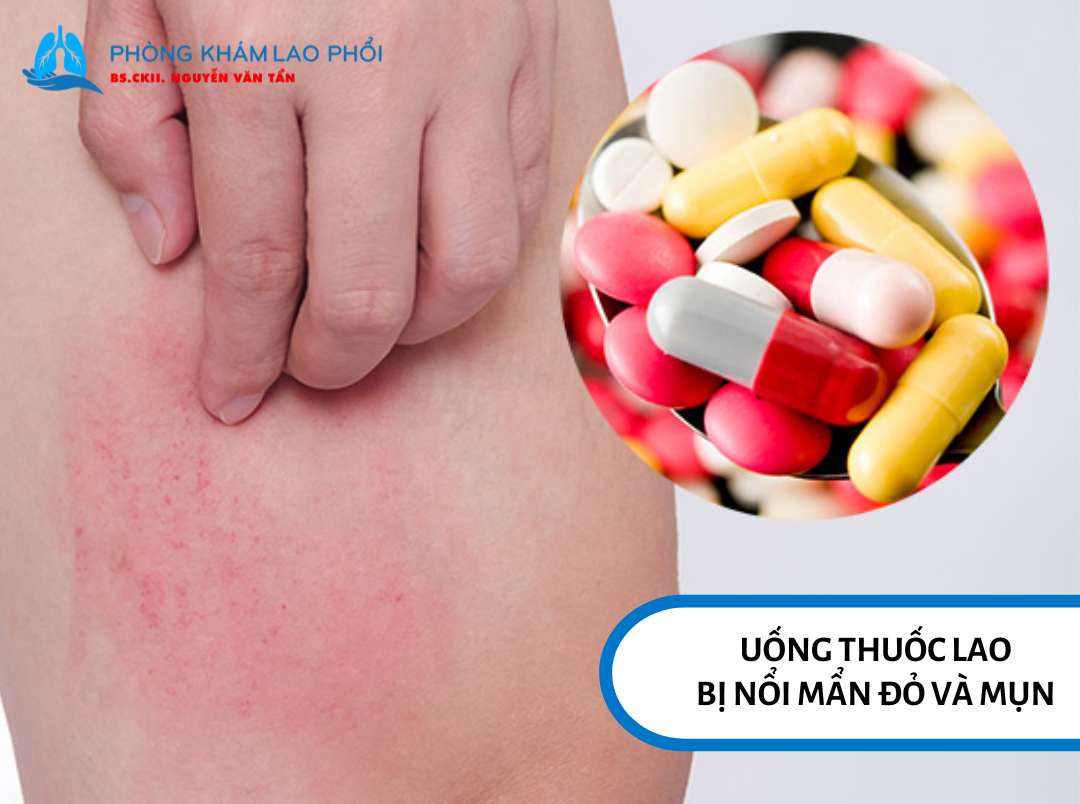 Nổi mẩn đỏ và mụn trên da khi uống thuốc lao