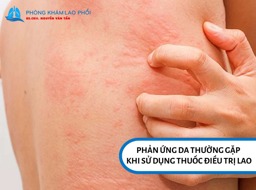 Nổi mẩn đỏ, ngứa là phản ứng thường gặp khi sử dụng thuốc điều trị lao