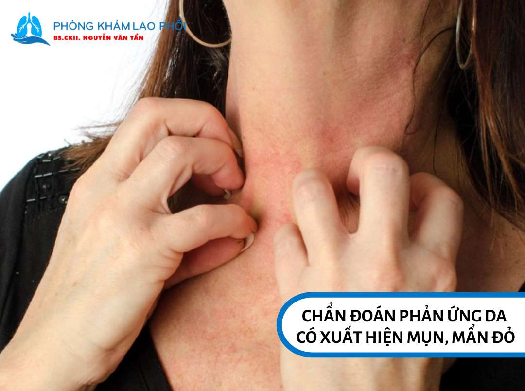 Chẩn đoán phản ứng da có xuất hiện mụn, mẩn đỏ