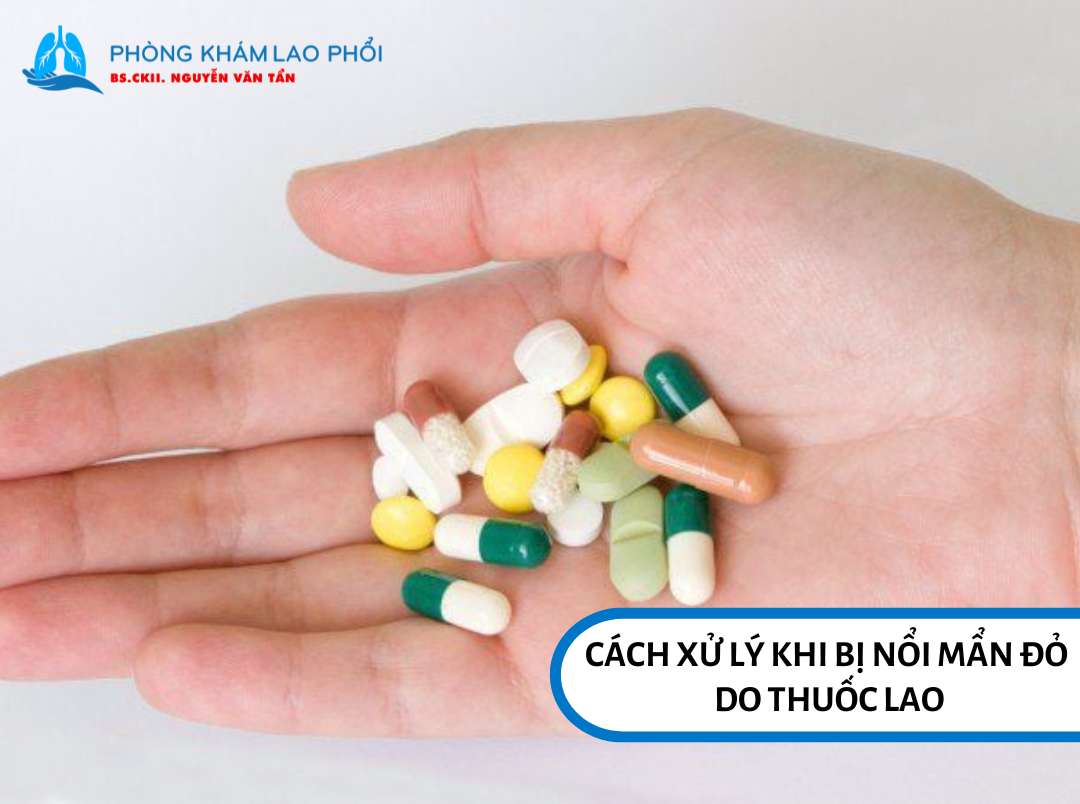 Cách xử lý khi bị nổi mẩn đỏ do thuốc lao       