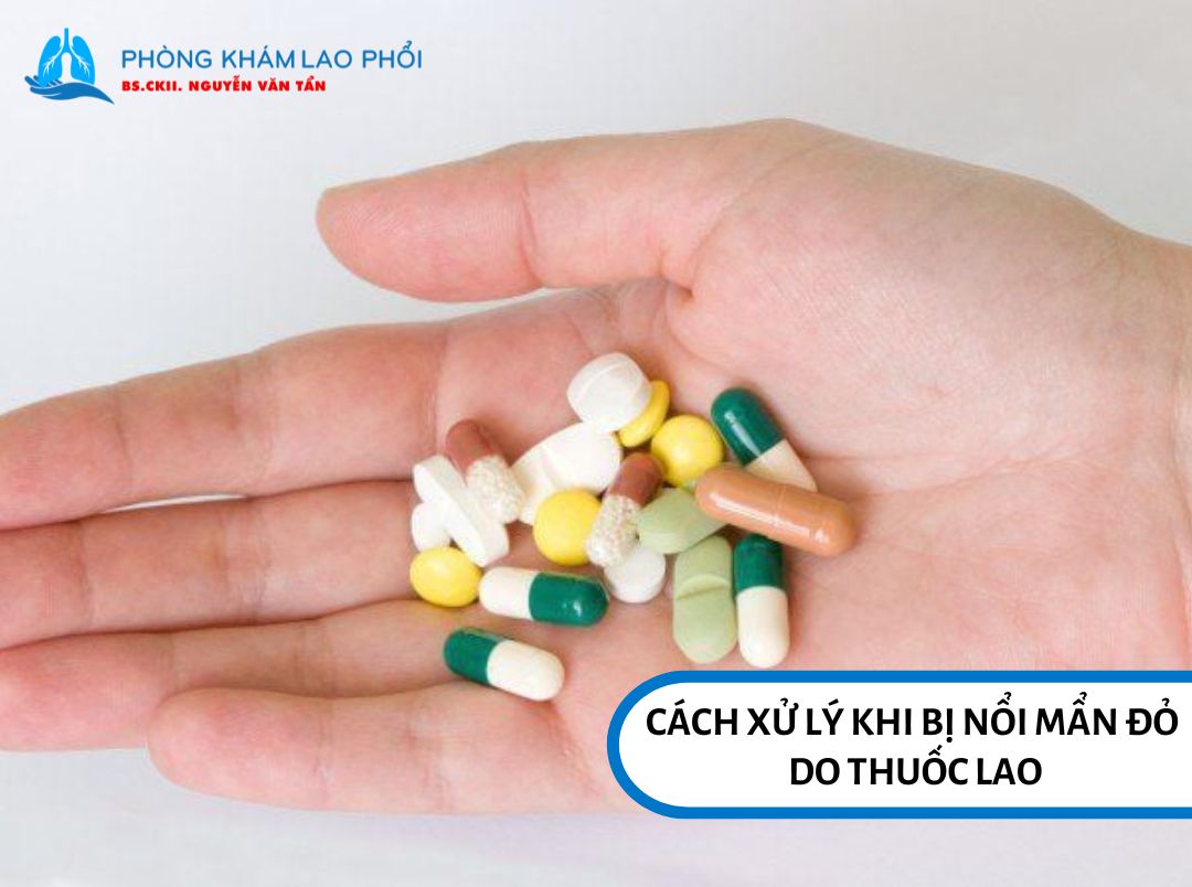 Cách xử lý khi bị nổi mẩn đỏ do thuốc lao
