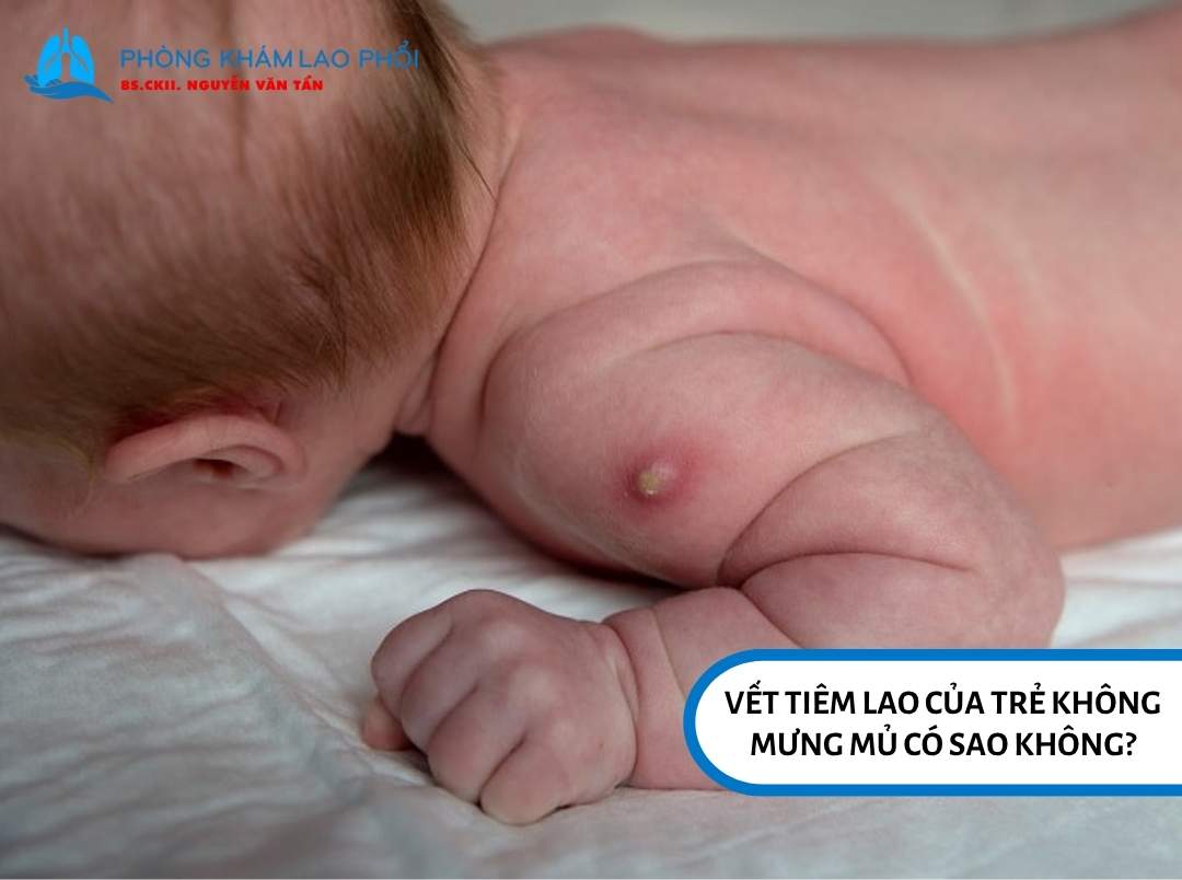 Vết tiêm lao không mưng mủ trong đa số trường hợp không phải là dấu hiệu bất thường