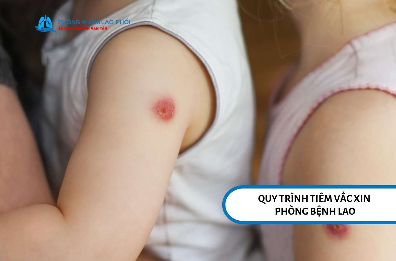 Quy trình tiêm vắc xin phòng bệnh lao