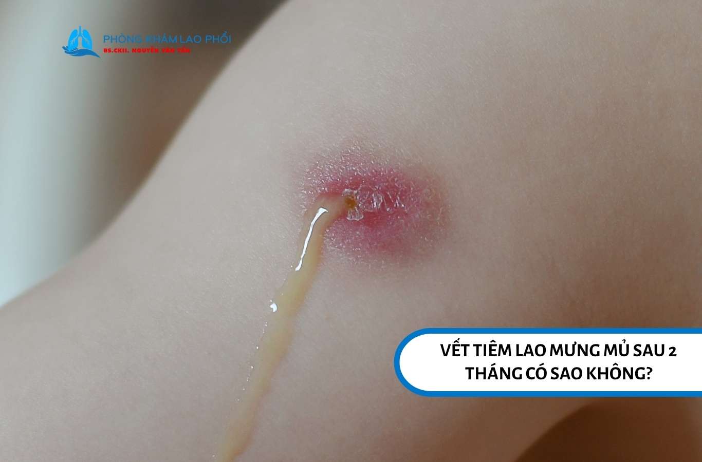 Vết tiêm lao mưng mủ sau 4 tháng có sao không?