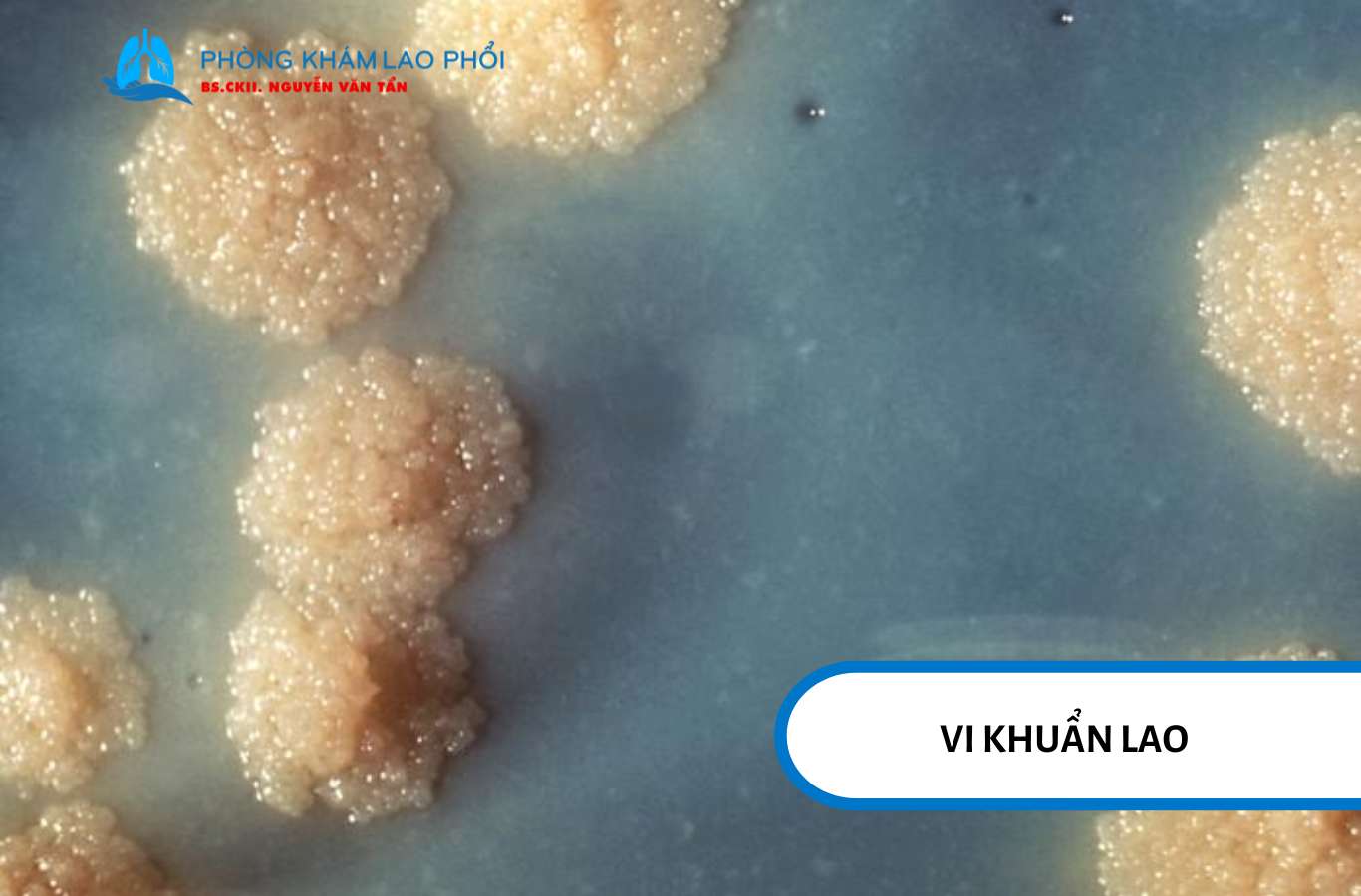 Vi khuẩn lao Mycobacterium tuberculosis
