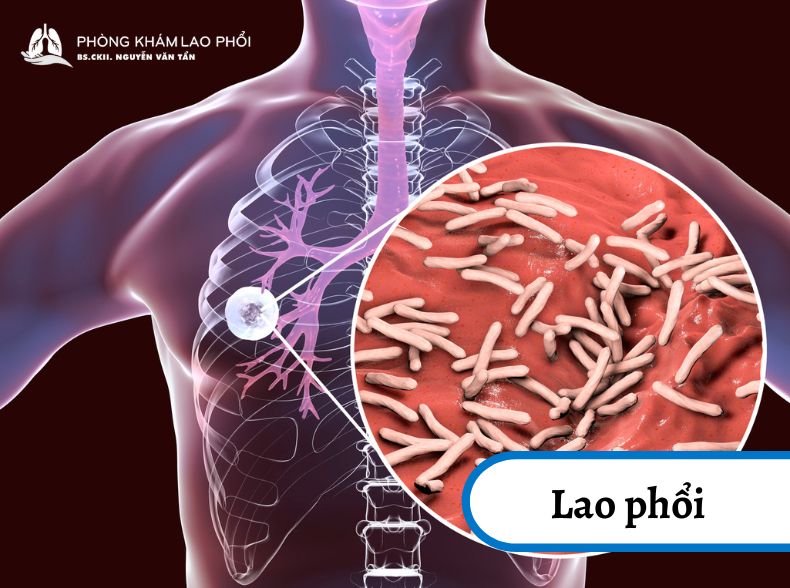 Lao phổi là bệnh truyền nhiễm do vi khuẩn lao gây nên tại phổi của bệnh nhân