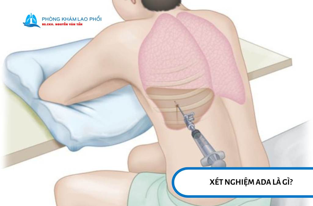 Xét nghiệm ADA là xét nghiệm đo một chất có tên Adenosine Deaminase trong màng phổi