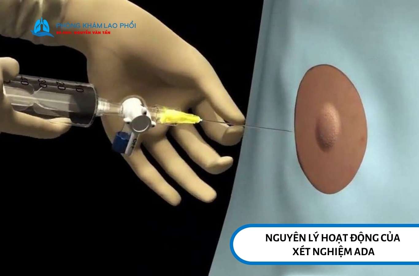 Xét nghiệm ADA giúp đo hoạt động của enzyme Adenosine Deaminase trong dịch màng phổi