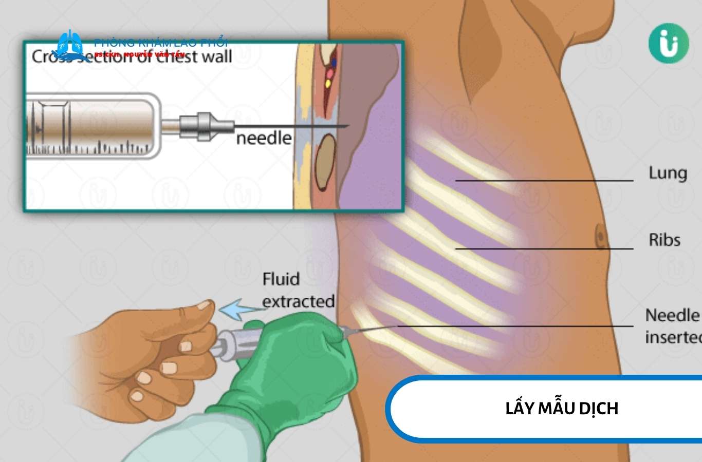 Bác sĩ sẽ dùng kim chọc vào khoang màng phổi để hút dịch