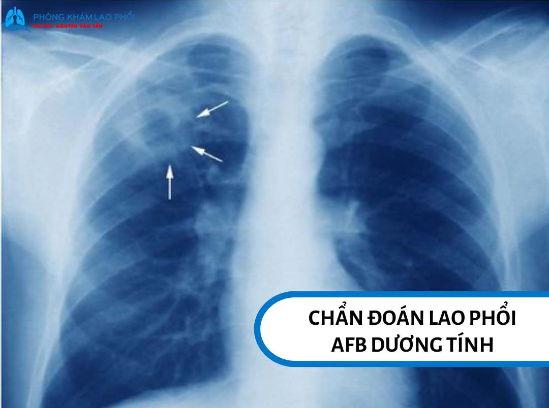 AFB dương tính được chẩn đoán khi xét nghiệm đờm phát hiện vi khuẩn lao theo các tiêu chuẩn chuyên môn