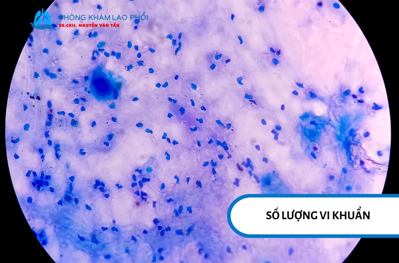 Mẫu đờm chứa nhiều vi khuẩn thì kết quả xét nghiệm thường nhanh hơn