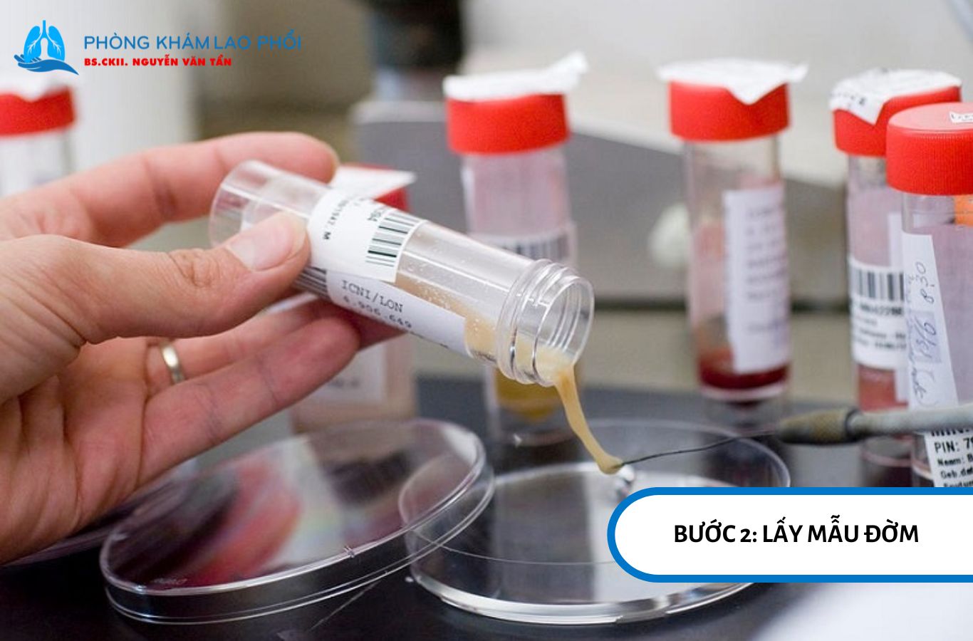 Lấy đúng mẫu đờm giúp tăng độ chính xác của xét nghiệm