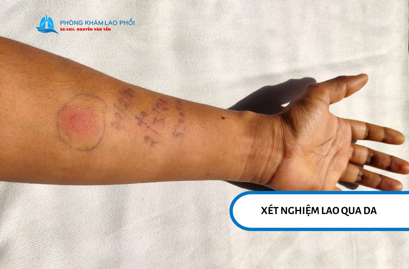 Có nhiều phương pháp xét nghiệm lao phổi ở trẻ em, từ test da đến xét nghiệm máu