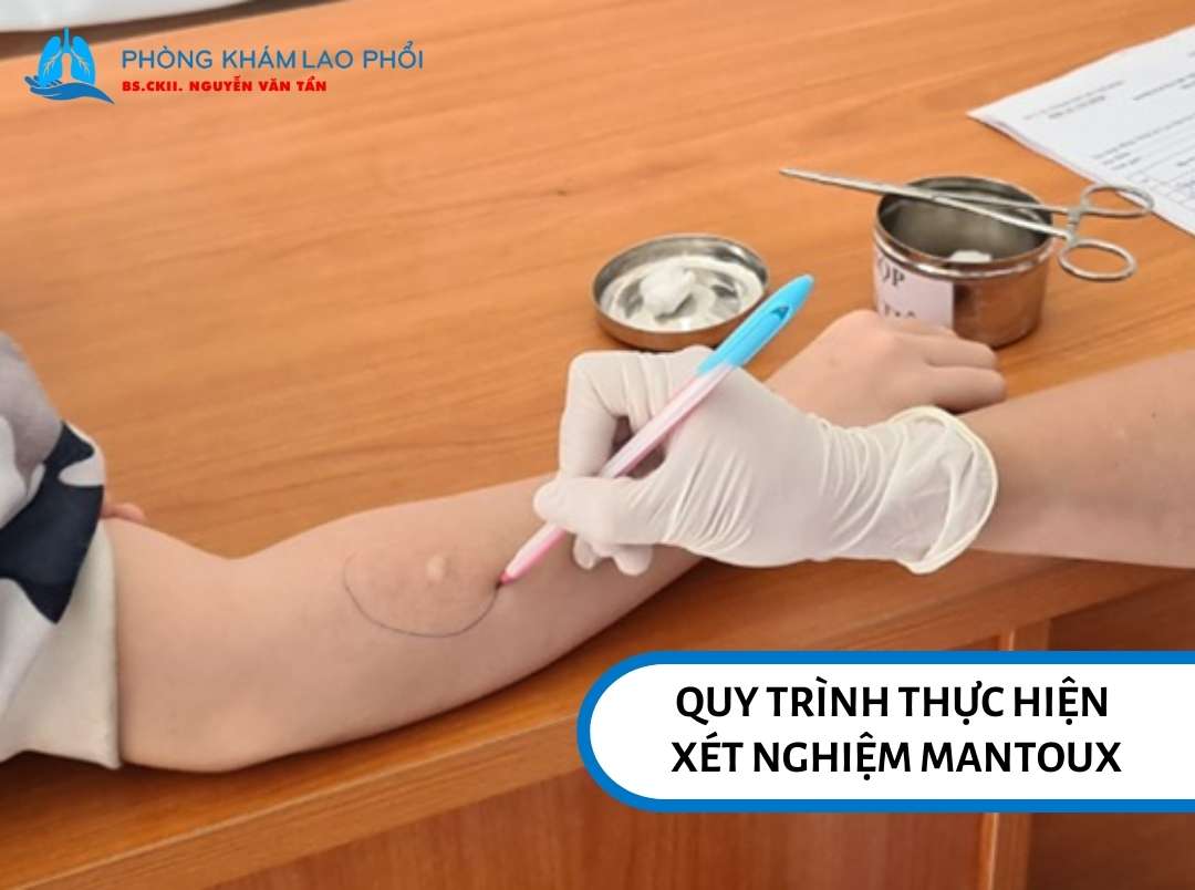 Quy trình thực hiện xét nghiệm Mantoux xác định bệnh lao