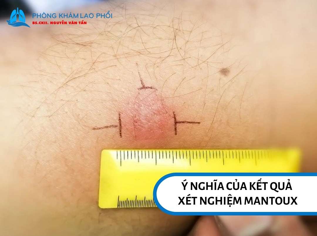 Ý nghĩa của kết quả xét nghiệm Mantoux