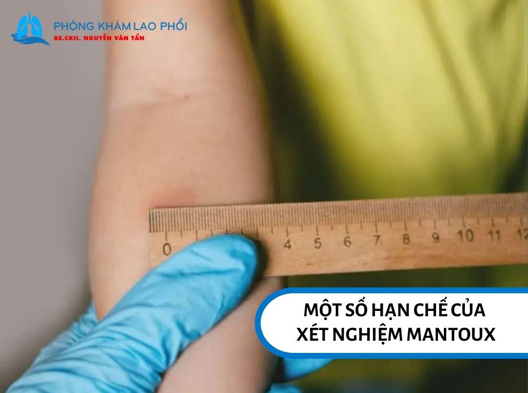 Một số hạn chế của xét nghiệm Mantoux