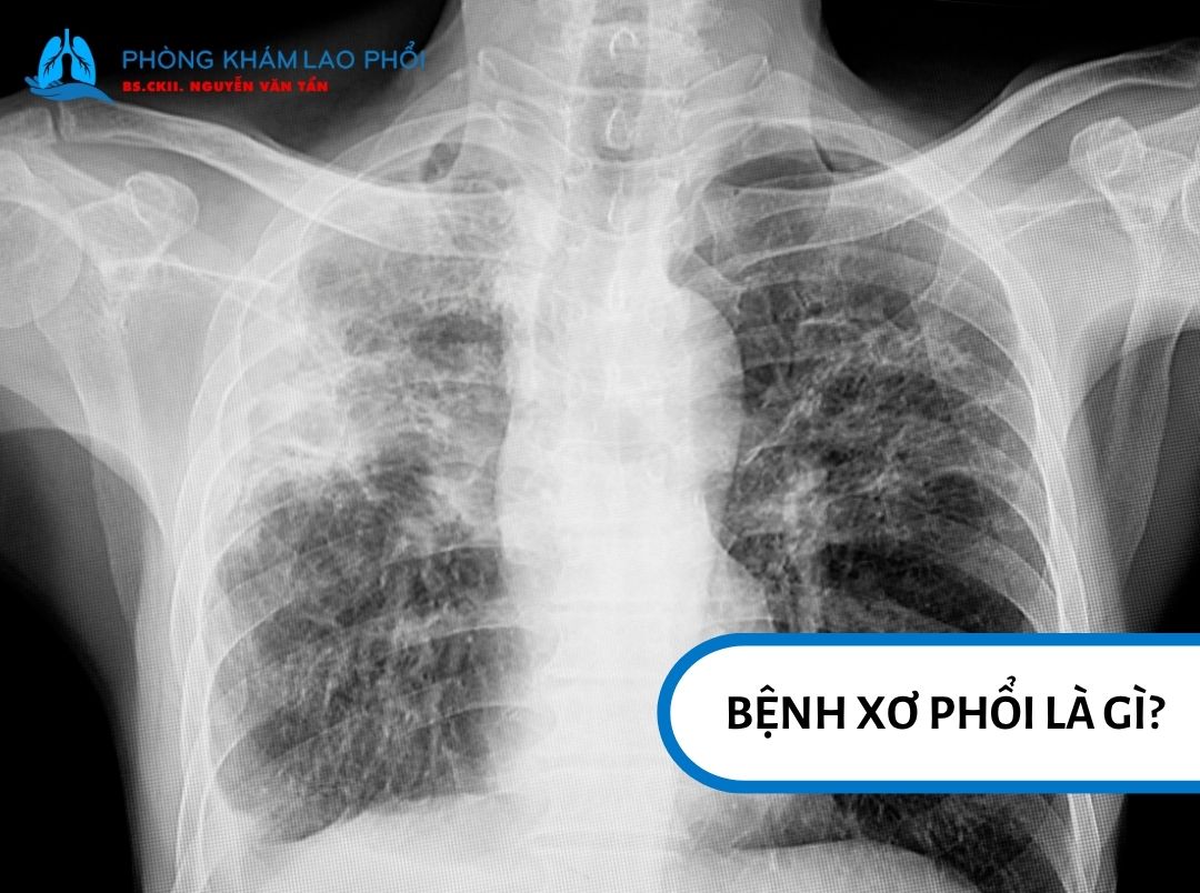 Xơ phổi là tình trạng mô phổi bị sẹo hóa, làm giảm độ đàn hồi và cản trở trao đổi oxy