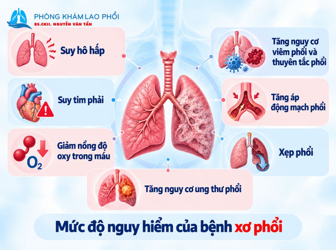 Xơ phổi có thể gây biến chứng nghiêm trọng như suy hô hấp, tăng áp phổi, suy tim phải và thiếu oxy máu