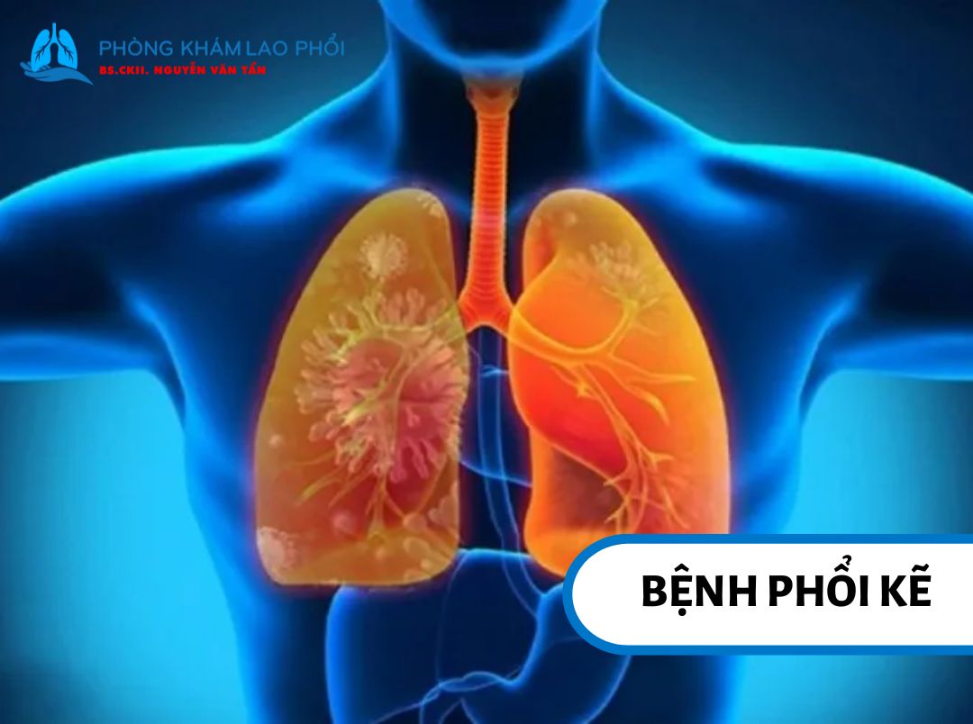 Tổn thương mô kẽ làm ảnh hưởng đến cấu trúc và chức năng phổi