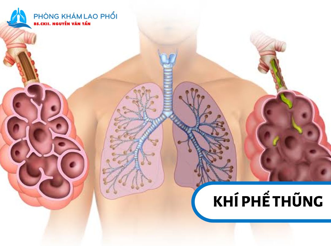 Thành phế nang bị phá hủy làm giảm khả năng trao đổi khí