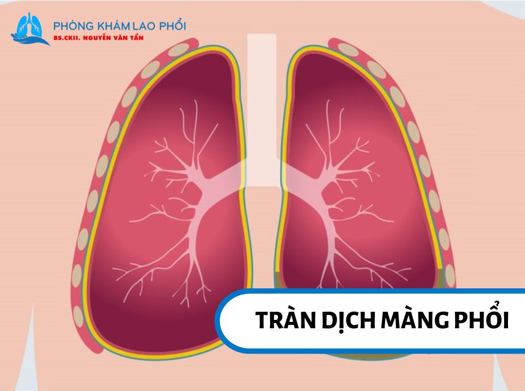 Dịch tích tụ trong khoang màng phổi gây chèn ép phổi