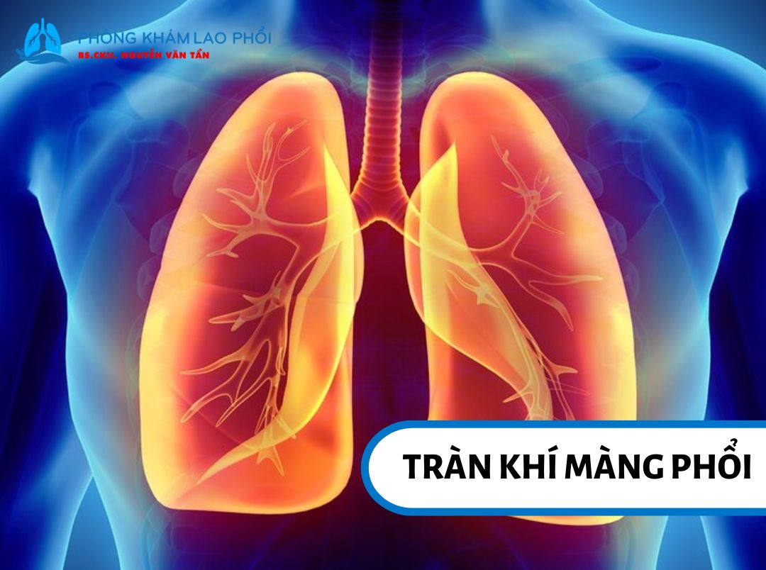 Không khí lọt vào khoang màng phổi khiến phổi bị xẹp