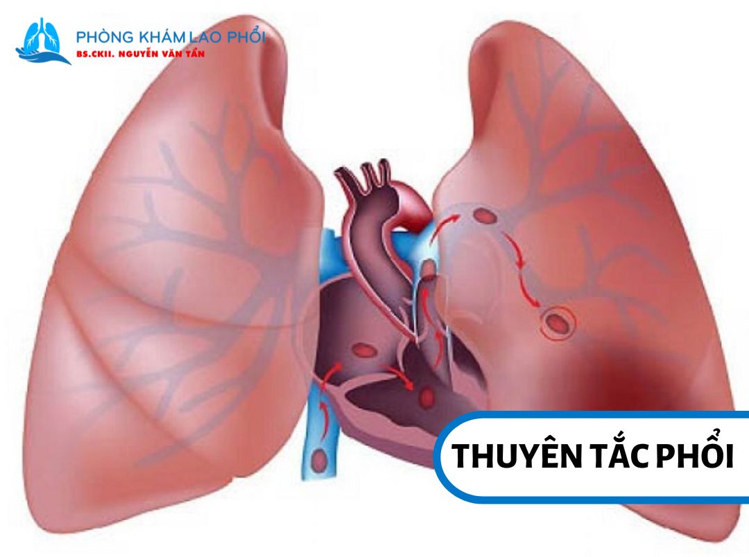 Cục máu đông di chuyển đến động mạch phổi và gây tắc nghẽn