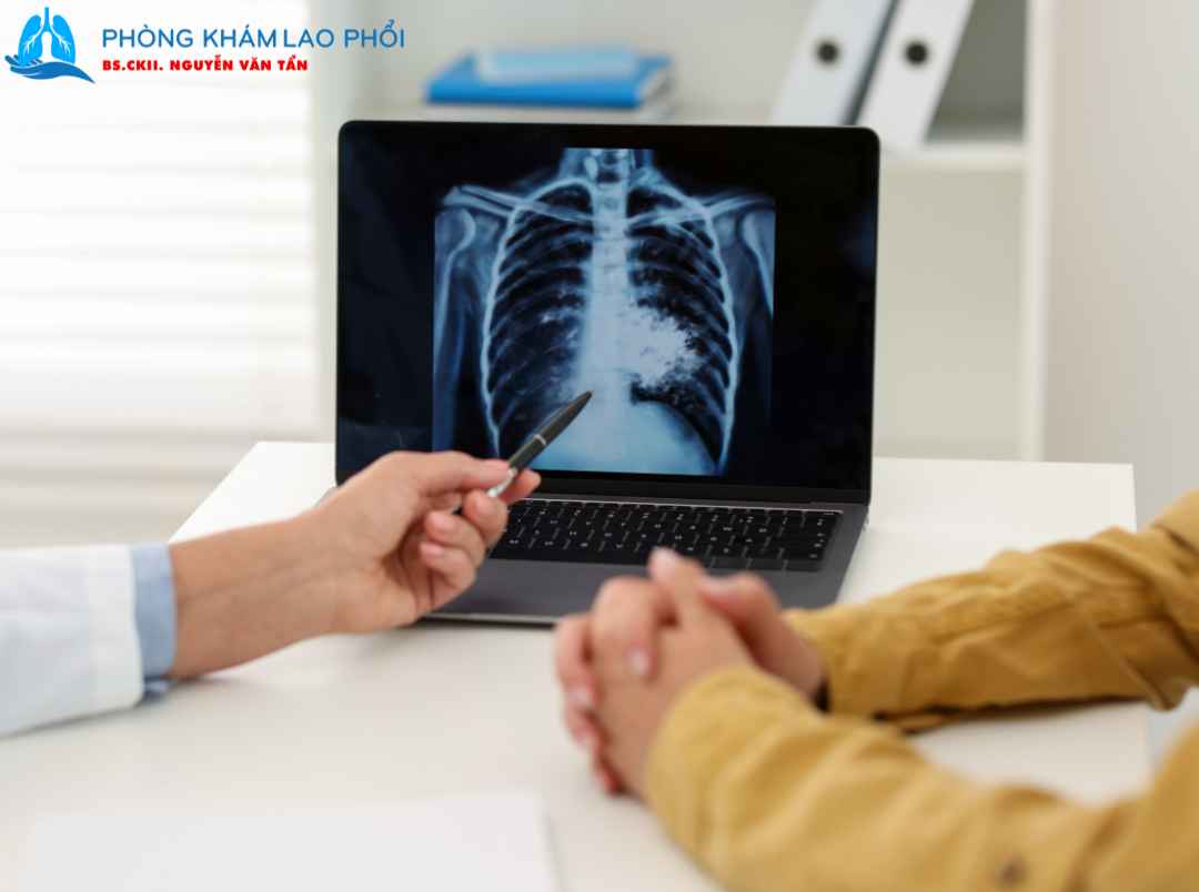 Lao phổi tái phát xuất hiện khi người bệnh được chẩn đoán mắc lao trở lại sau khi đã điều trị khỏi trước đó