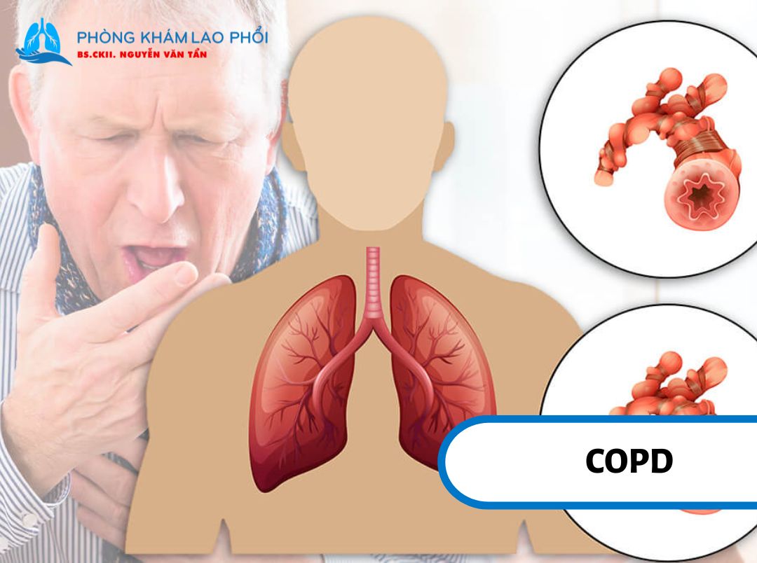  COPD gây hẹp đường thở và cản trở luồng khí trong phổi