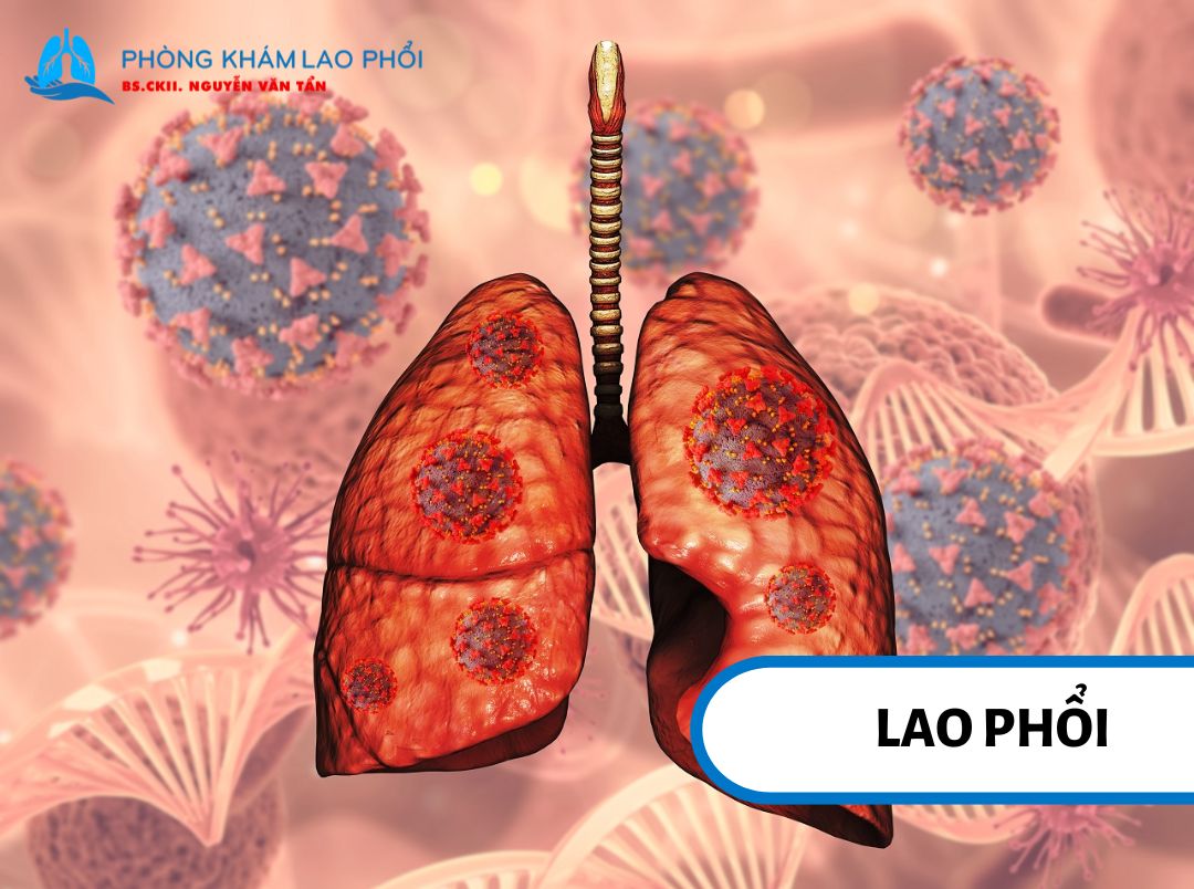 Hình ảnh tổn thương phổi do vi khuẩn lao gây ra